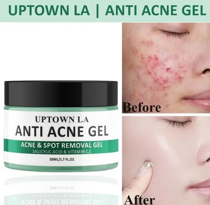 Uptown La Acne Scar Removal Exfoliating Gel