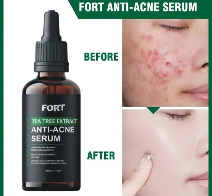 Uptown La Anti-Acne Face Serum